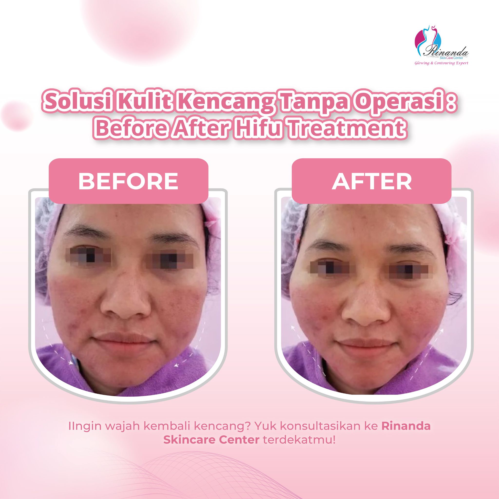 testimoni hifu treatment
